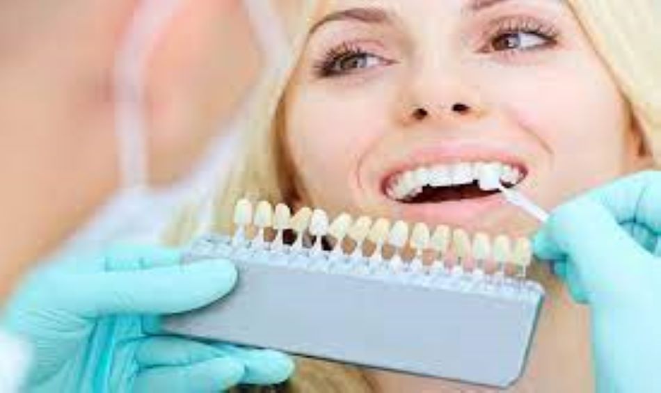 Dental Veneers